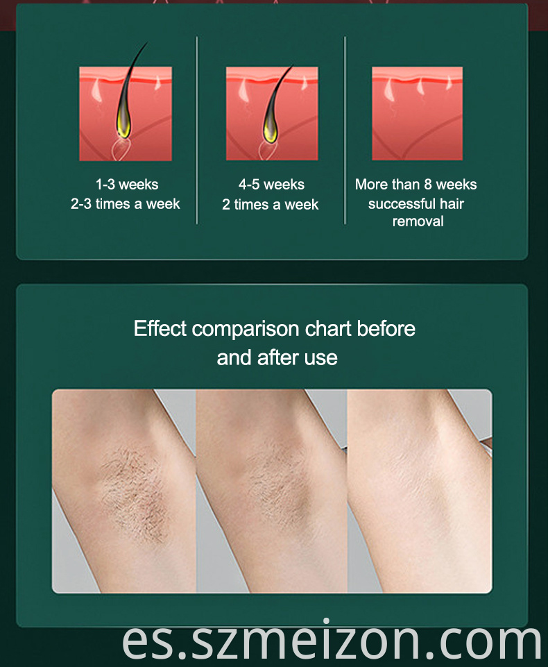 alma laser soprano ice hair removal reviews